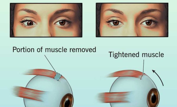 Squint Treatment in Adults