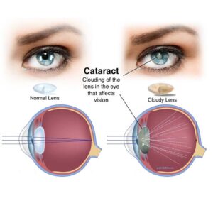 cataract-lens-FW-eyes-1024x811-1-300x300