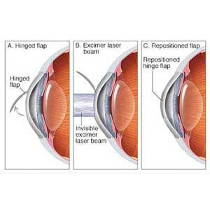 mcdc7_lasik