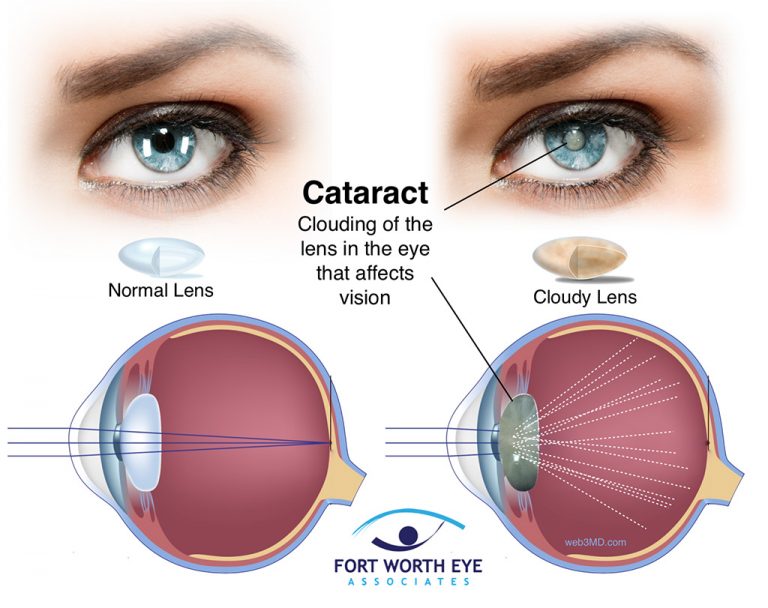 cataract-lens-FW-eyes-768x608