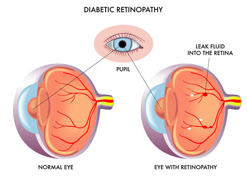 diabetic_retinopathy